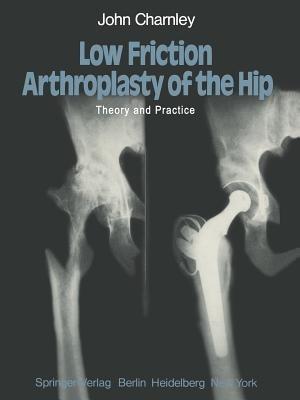 Low Friction Arthroplasty of the Hip: Theory and Practice - J. Charnley - cover